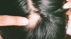 cellule staminali per la ricrescita dei capelli